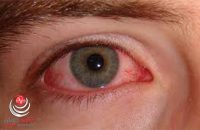 علل آسیب های چشمی